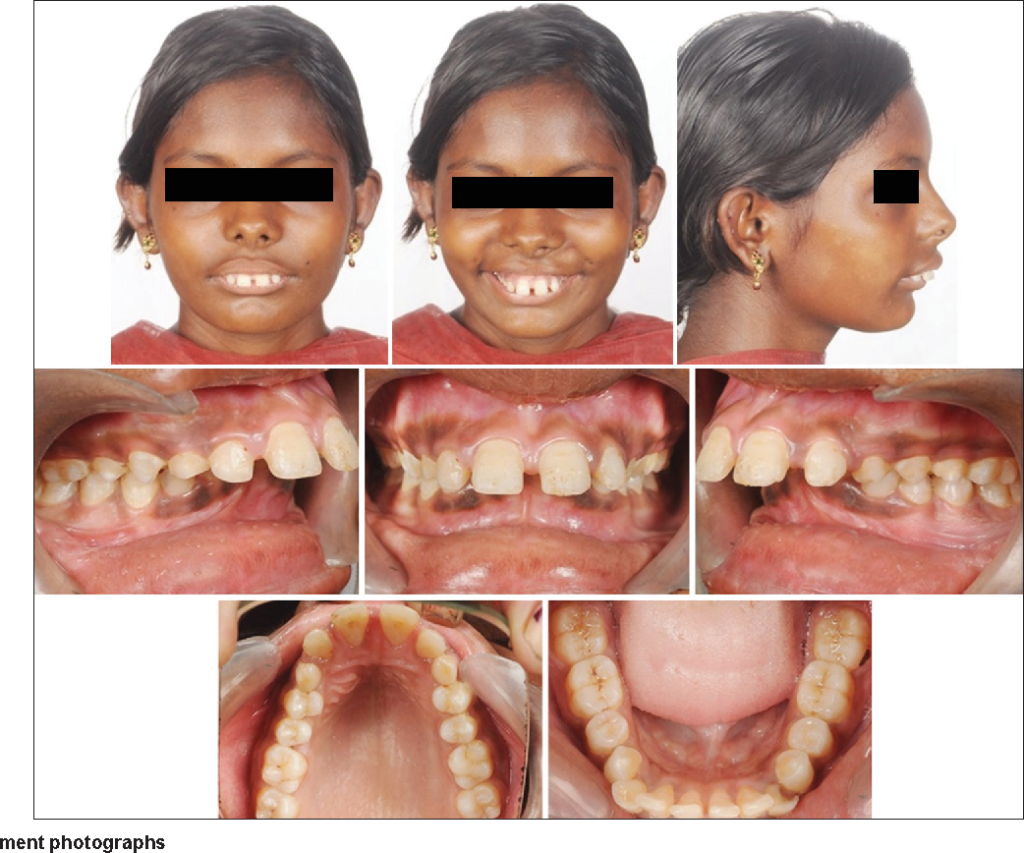 Before & After Early Orthodontic Treatment