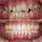 Clear Aligners in Chengannur, Kerala