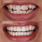 Clear Aligners in Chengannur, Kerala