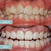 Clear Aligners in Chengannur, Kerala