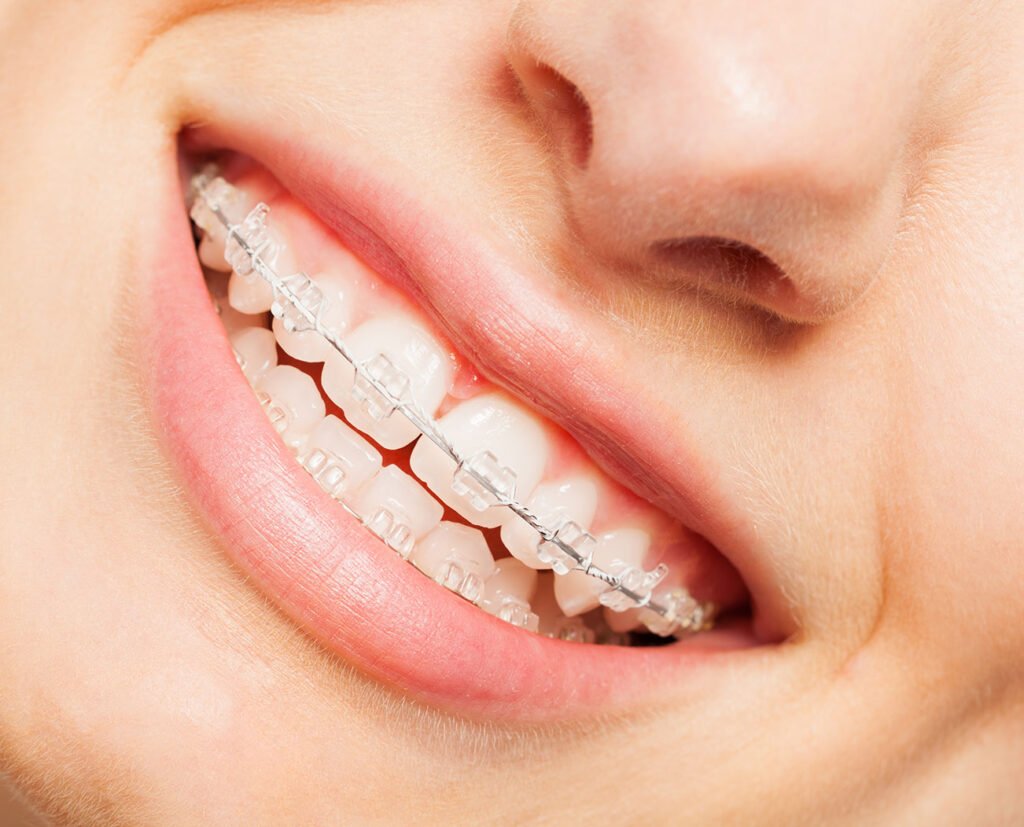 Ceramic braces Chengannur