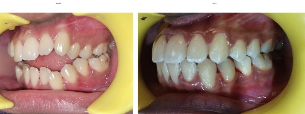 clear aligners before after collage