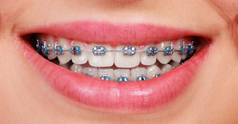 braces treatment in chengannur