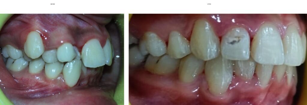 orthodontic case before after collage