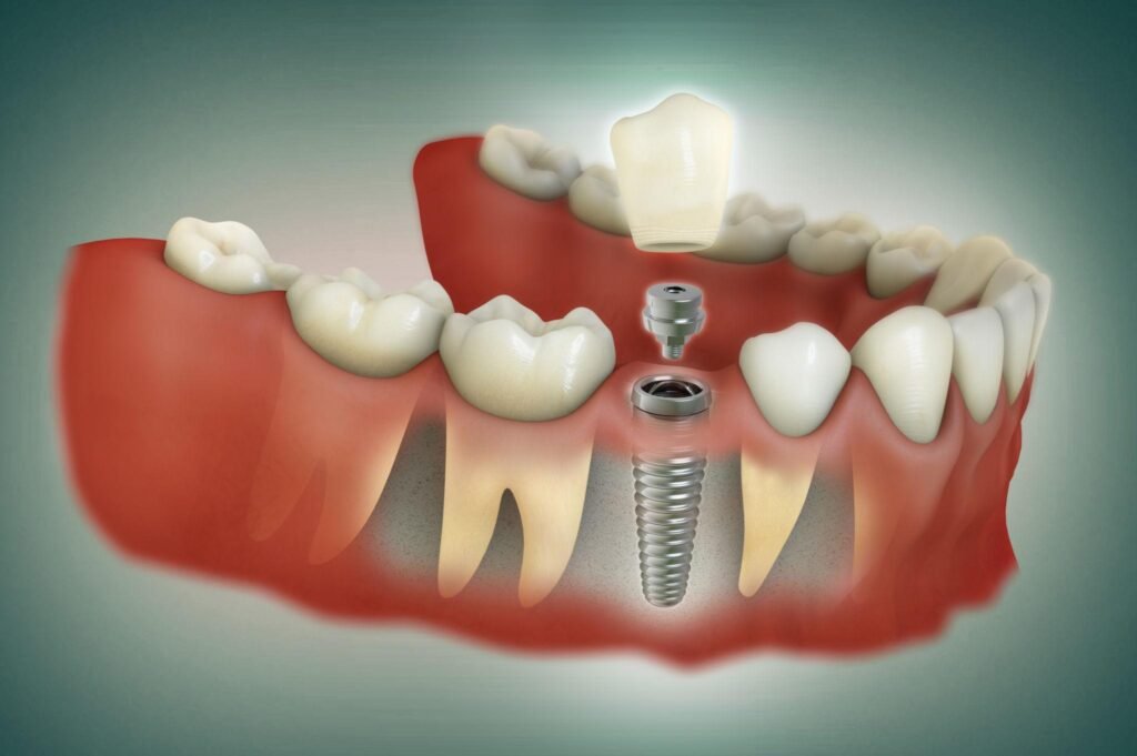 dental implants in chengannur