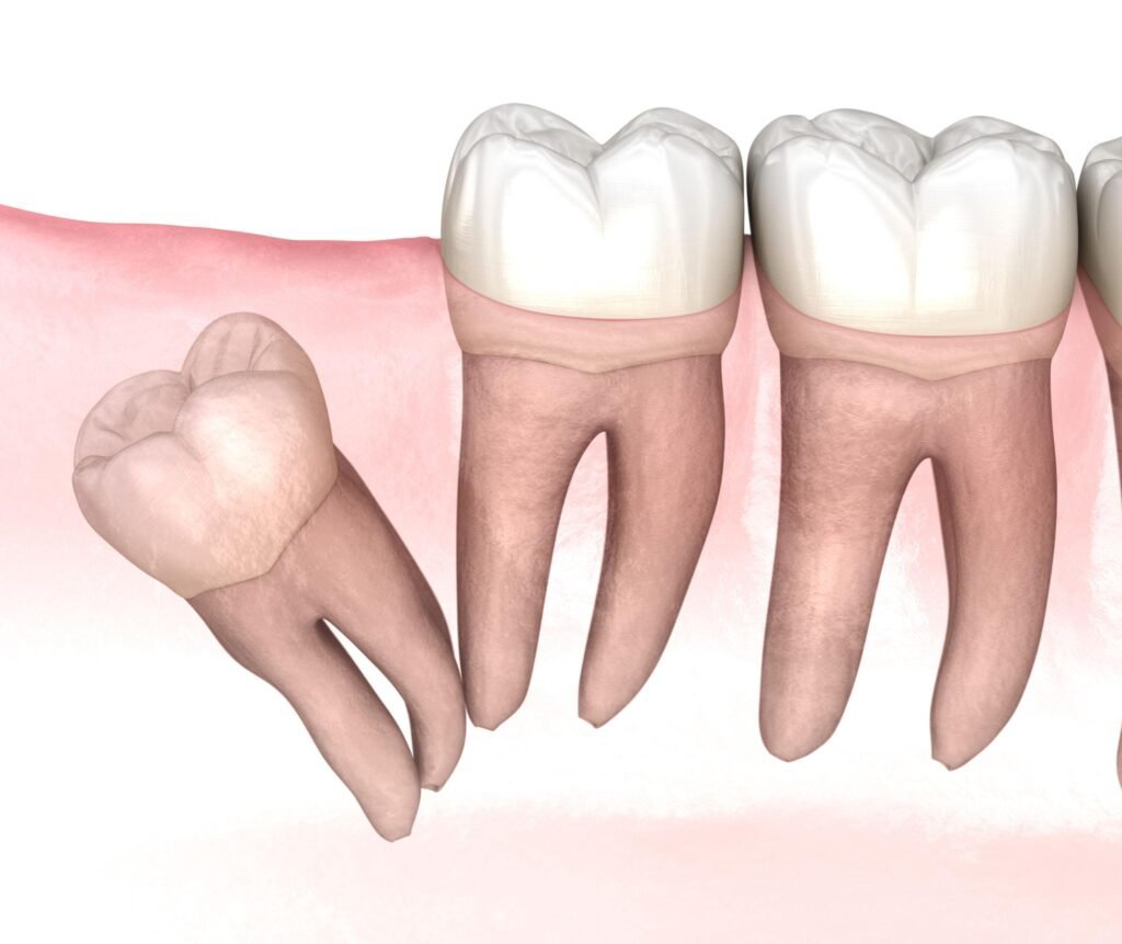 wisdom tooth impaction dental illustration
